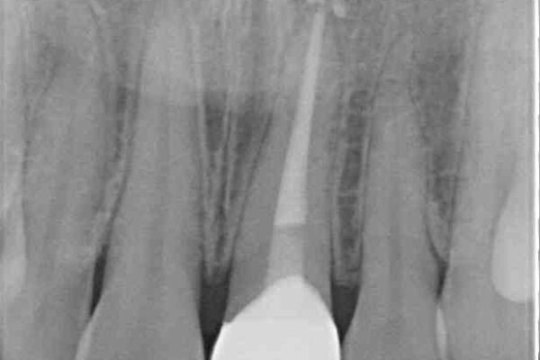 変色した前歯をオールセラミッククラウンに 治療後画像