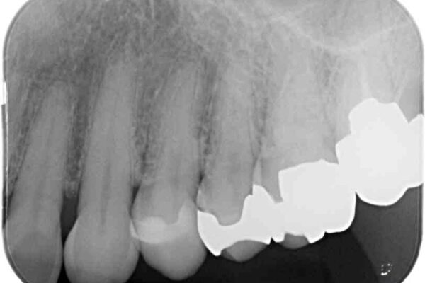 外れてしまった銀歯　セラミックインレーで自然な仕上がりに 治療後画像