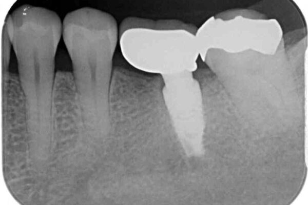 しみる奥歯　オールセラミッククラウンによる補綴治療 治療前画像