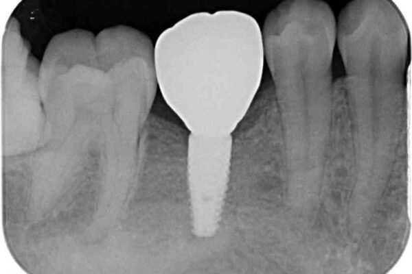 空いている時間を利用して通院　奥歯のインプラント治療 治療後画像