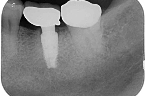 しみる奥歯　オールセラミッククラウンによる補綴治療 治療後画像