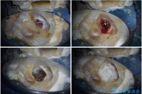 治療をしても違和感の続く奥歯　神経を極力残した虫歯治療 治療途中画像