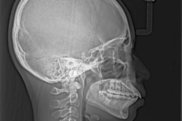 【モニター】口が閉じられない　ワイヤー装置での抜歯矯正 治療前画像