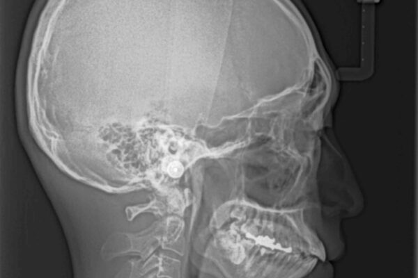 口元の突出感を改善!目立ちにくいワイヤー矯正で自信を持てる自然な横顔に 治療前画像