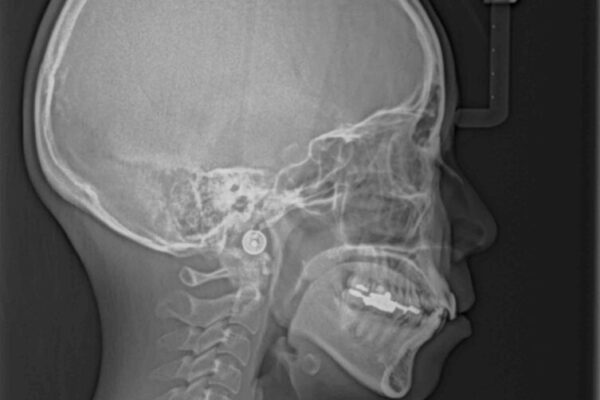デコボコと口元の突出感　ハーフリンガルでの抜歯矯正 治療前画像