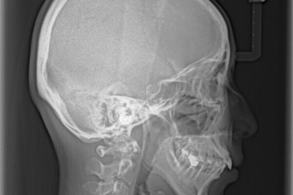 【モニター】出っ歯と咬み合わせを改善　ワイヤー装置の抜歯矯正 治療前画像