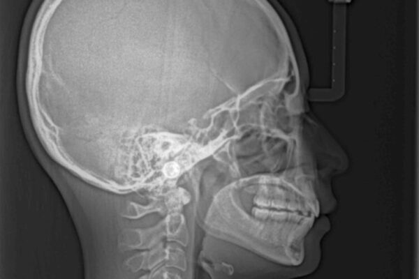 【モニター】口が閉じられない　ワイヤー装置での抜歯矯正 治療後画像