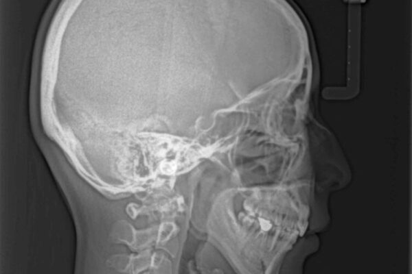 【モニター】出っ歯と咬み合わせを改善　ワイヤー装置の抜歯矯正 治療後画像