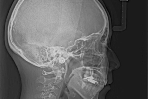 デコボコと口元の突出感　ハーフリンガルでの抜歯矯正 治療後画像