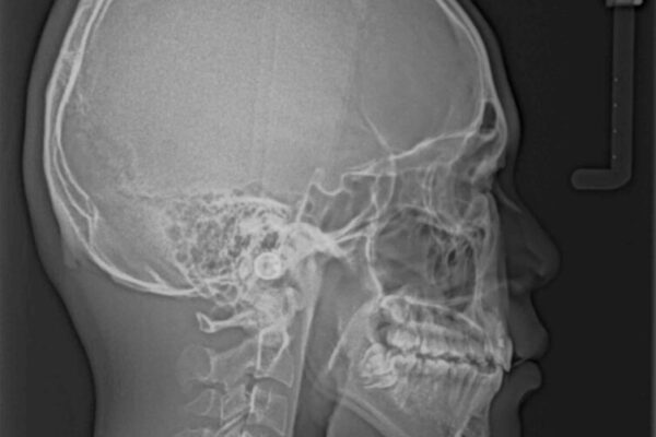 膨らんだ口元　ワイヤー装置での抜歯矯正 治療後画像