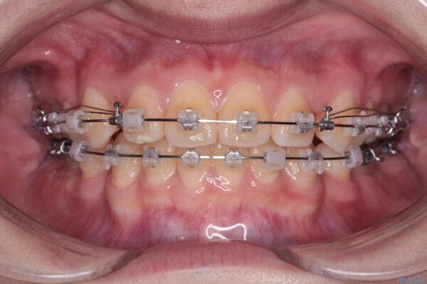 転勤でも安心して治療継続　抜歯スペース閉鎖と深い噛み合わせ改善のワイヤー矯正 治療途中画像