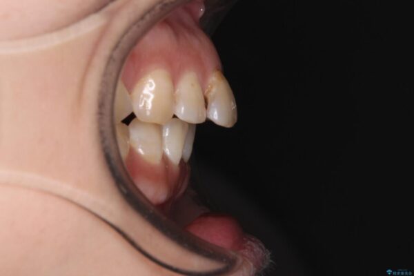 【モニター】飛び出た前歯を整えたい　ワイヤー矯正治療 ビフォー