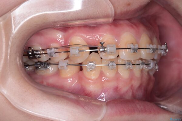 転勤でも安心して治療継続　抜歯スペース閉鎖と深い噛み合わせ改善のワイヤー矯正 治療途中画像