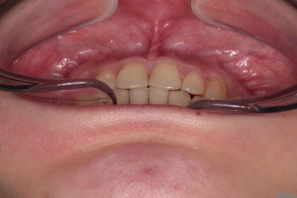 治療途中の奥歯と矯正治療の後戻り　インビザライン・ライトによる矯正治療 治療後画像