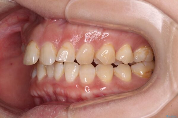 【モニター】飛び出た前歯を整えたい　ワイヤー矯正治療 治療前画像