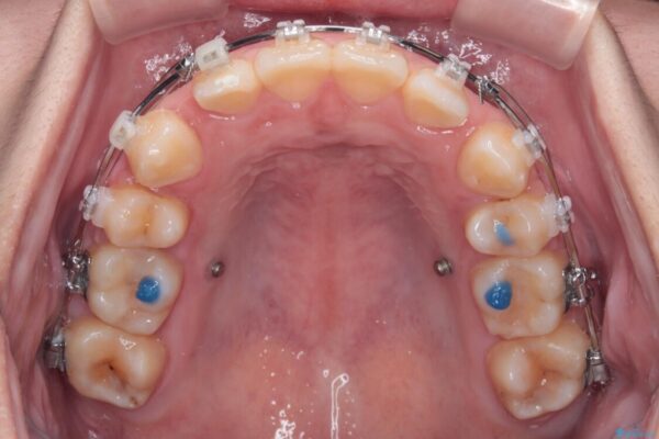転勤でも安心して治療継続　抜歯スペース閉鎖と深い噛み合わせ改善のワイヤー矯正 治療途中画像