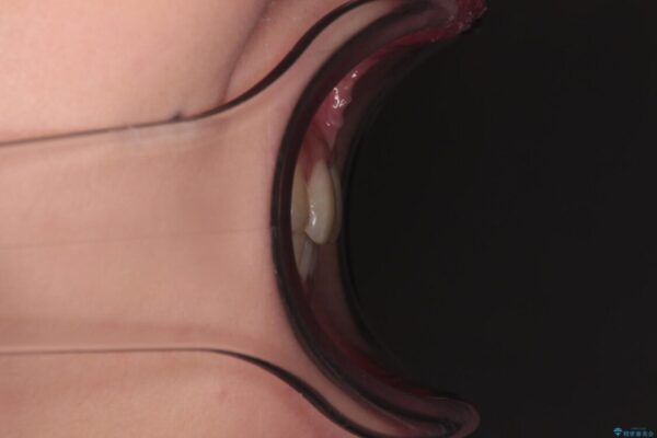 治療途中の奥歯と矯正治療の後戻り　インビザライン・ライトによる矯正治療 治療後画像