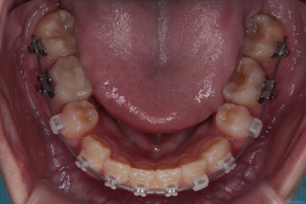 転勤でも安心して治療継続　抜歯スペース閉鎖と深い噛み合わせ改善のワイヤー矯正 治療途中画像