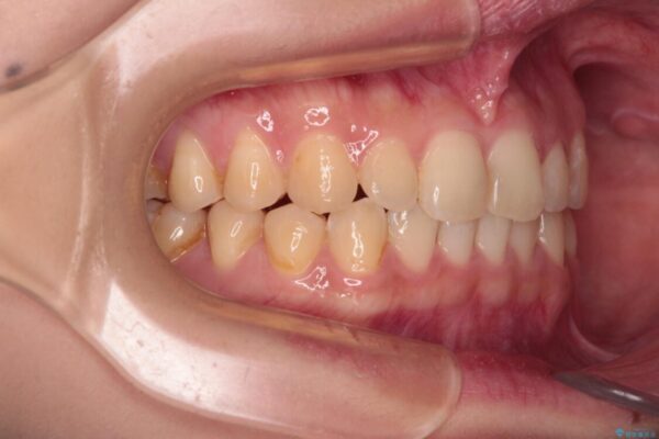 治療途中の奥歯と矯正治療の後戻り　インビザライン・ライトによる矯正治療 治療後画像