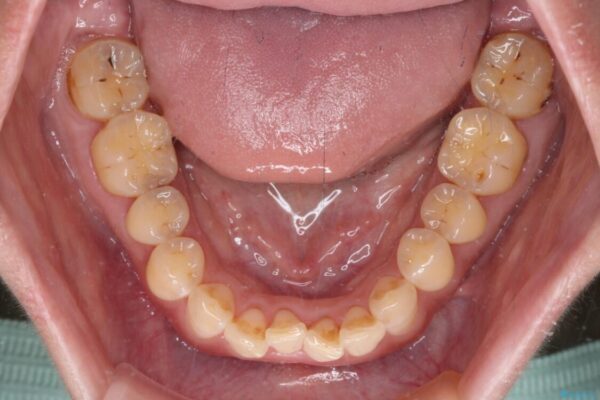 【モニター】飛び出た前歯を整えたい　ワイヤー矯正治療 治療前画像