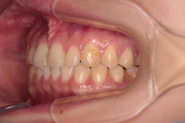 治療途中の奥歯と矯正治療の後戻り　インビザライン・ライトによる矯正治療 治療後画像