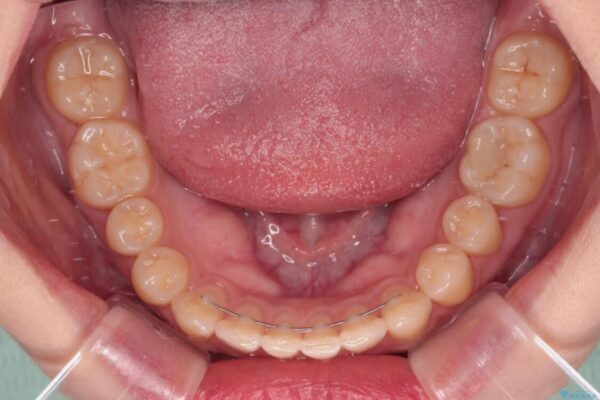 治療途中の奥歯と矯正治療の後戻り　インビザライン・ライトによる矯正治療 治療後画像