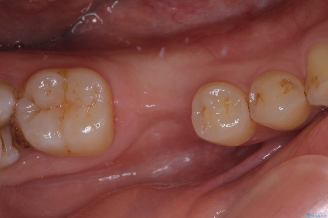 空いている時間を利用して通院　奥歯のインプラント治療 治療前