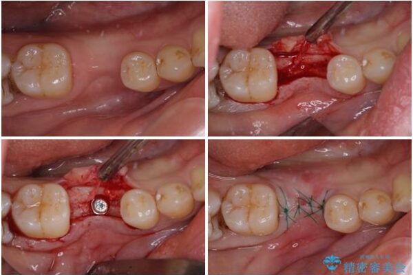 空いている時間を利用して通院　奥歯のインプラント治療 治療途中画像