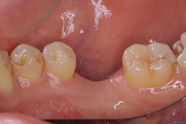 空いている時間を利用して通院　奥歯のインプラント治療 治療前画像