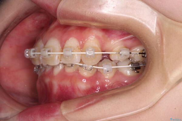 デコボコと深い咬み合わせ　ワイヤー装置での抜歯矯正 治療途中画像