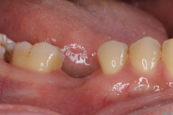 空いている時間を利用して通院　奥歯のインプラント治療 治療前画像