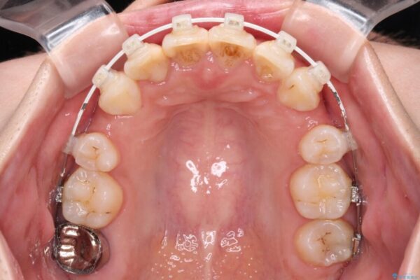 デコボコと深い咬み合わせ　ワイヤー装置での抜歯矯正 治療途中画像