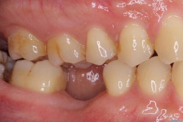 空いている時間を利用して通院　奥歯のインプラント治療 治療前画像