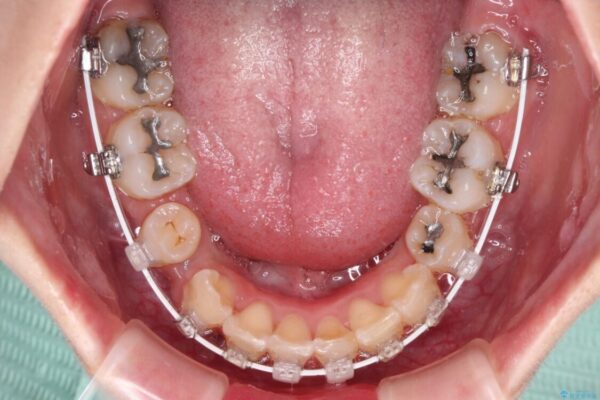 デコボコと深い咬み合わせ　ワイヤー装置での抜歯矯正 治療途中画像
