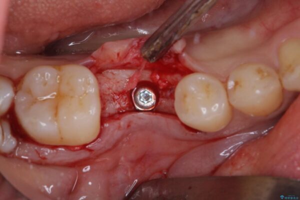 空いている時間を利用して通院　奥歯のインプラント治療 治療途中画像