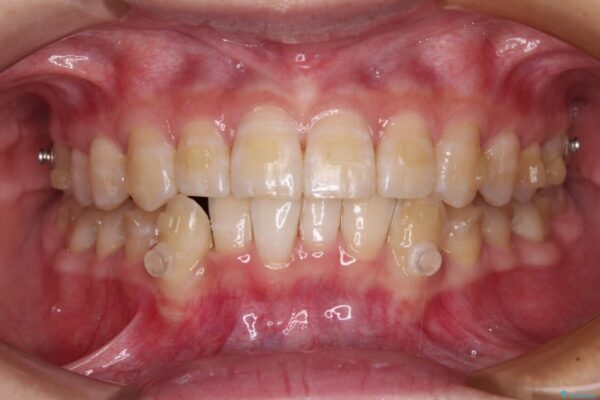 【モニター】下顎前歯のデコボコをインビザラインできれいに 治療途中画像