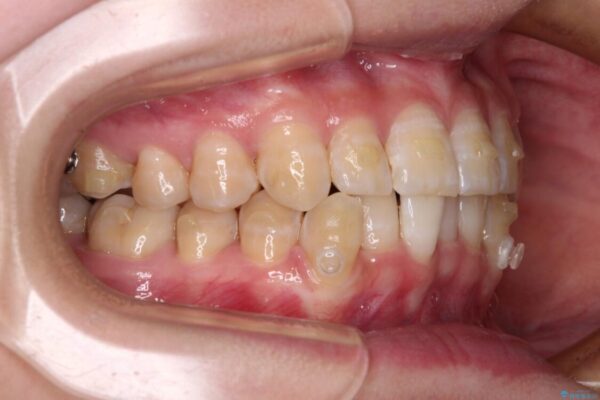 【モニター】下顎前歯のデコボコをインビザラインできれいに 治療途中画像