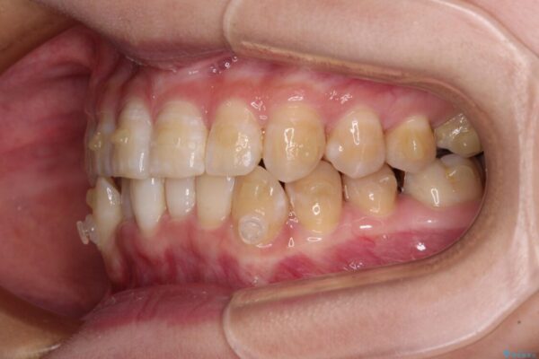 【モニター】下顎前歯のデコボコをインビザラインできれいに 治療途中画像