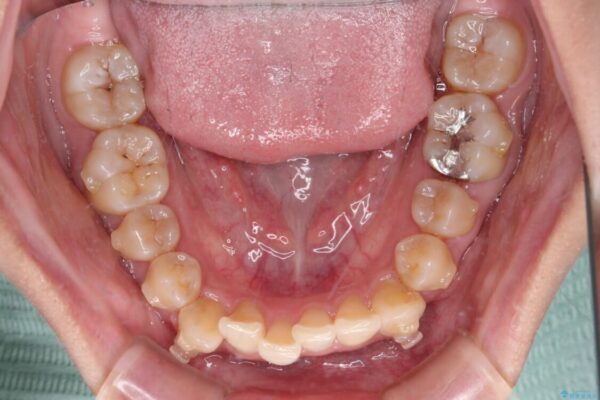 【モニター】下顎前歯のデコボコをインビザラインできれいに 治療途中画像