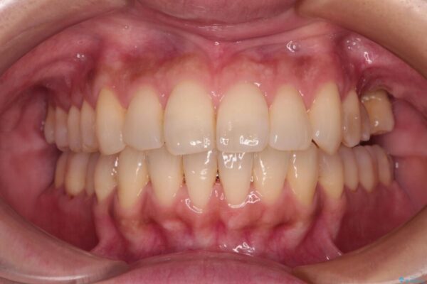 インビザラインによる矯正治療と奥歯のインプラント治療 治療途中画像