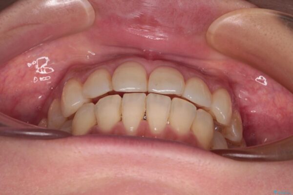 インビザラインによる矯正治療と奥歯のインプラント治療 治療途中画像