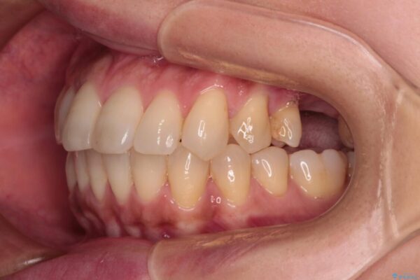 インビザラインによる矯正治療と奥歯のインプラント治療 治療途中画像