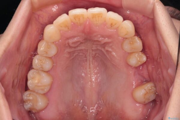 インビザラインによる矯正治療と奥歯のインプラント治療 治療途中画像