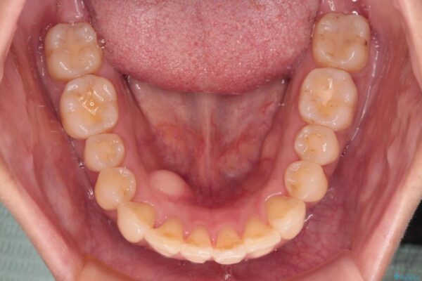 インビザラインによる矯正治療と奥歯のインプラント治療 治療途中画像