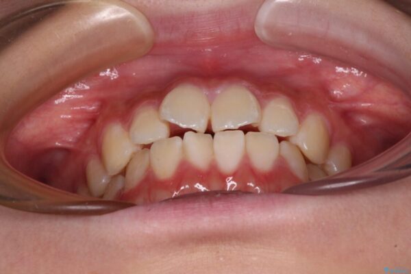 インビザラインは使える自信がない　ワイヤー装置にて矯正治療 治療前画像