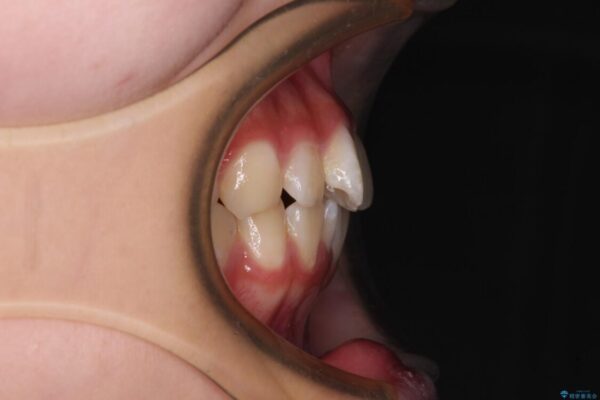 インビザラインは使える自信がない　ワイヤー装置にて矯正治療 治療前画像