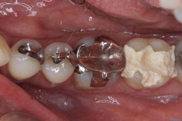 治療をしても違和感の続く奥歯　神経を極力残した虫歯治療 治療前画像