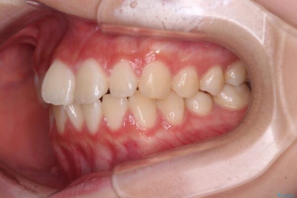 インビザラインは使える自信がない　ワイヤー装置にて矯正治療 治療前画像