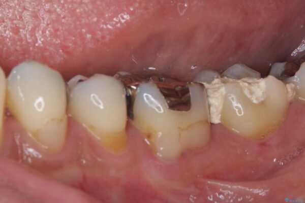 治療をしても違和感の続く奥歯　神経を極力残した虫歯治療 治療前画像