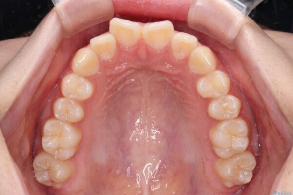 インビザラインは使える自信がない　ワイヤー装置にて矯正治療 治療前画像